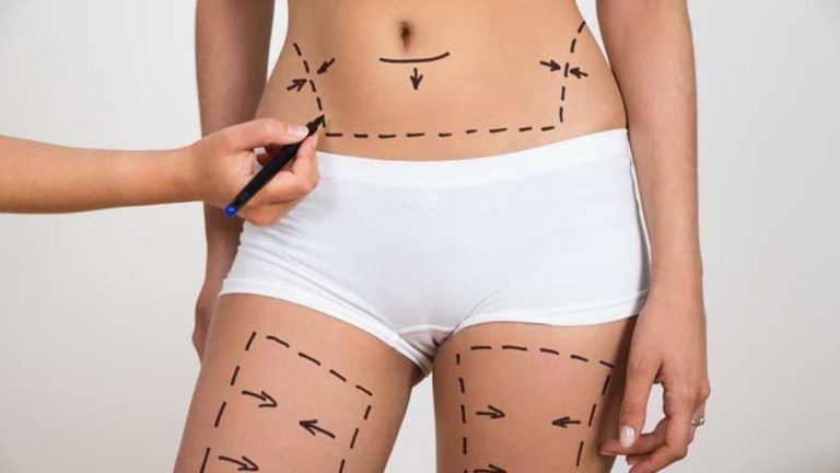 “Sezaryen karın germe” ameliyatlarının tehlikesi.